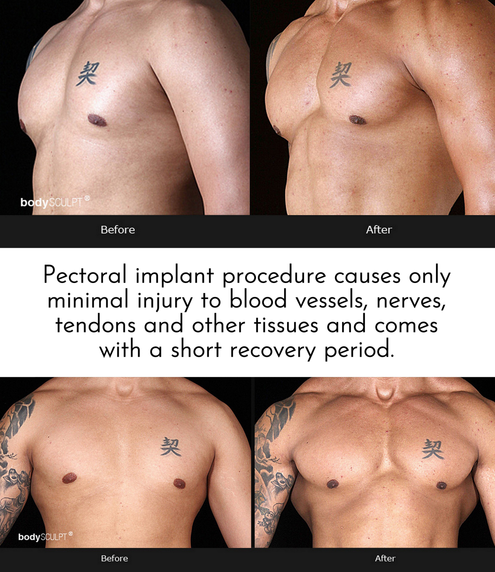 Pectoral Implants - Pecs, Male Chest Reconstruction, Male Plastic